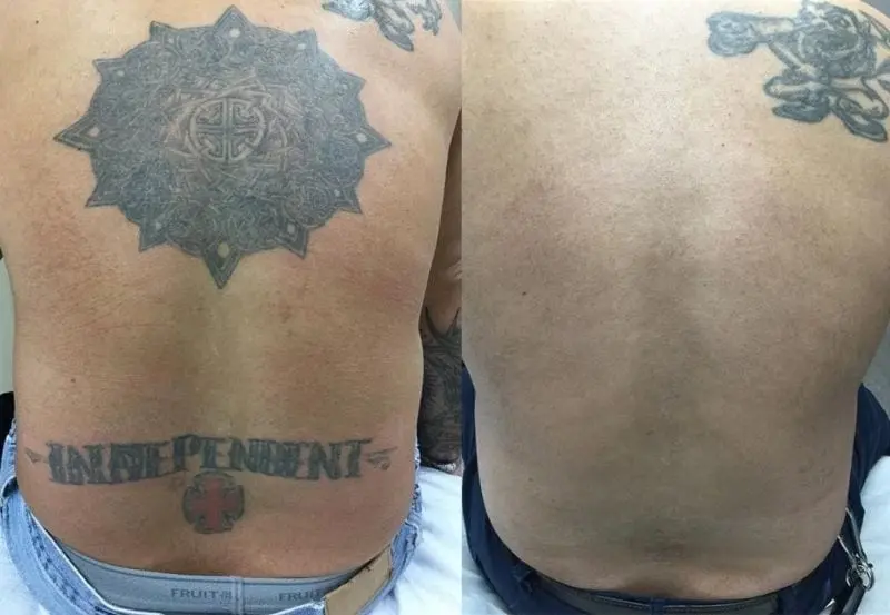 Real Tattoo Removal Before and After Photos